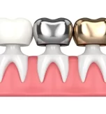 dental-crowns-everything-you-need-to-know