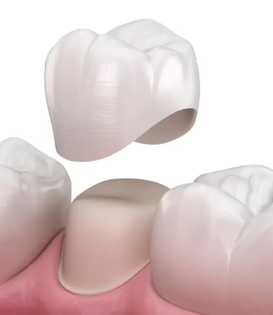 rediscover-your-perfect-smile-with-dental-bridges