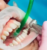 teeth-cleaning-importance-procedure-and-tips-for-a-healthy-smile