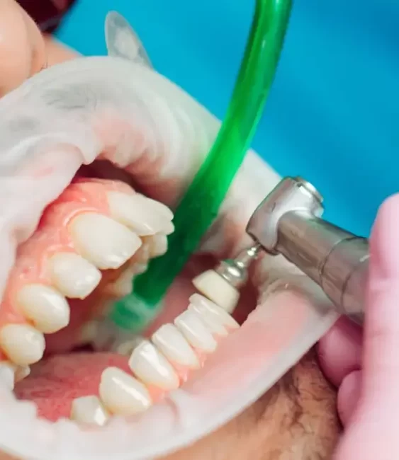 teeth-cleaning-importance-procedure-and-tips-for-a-healthy-smile