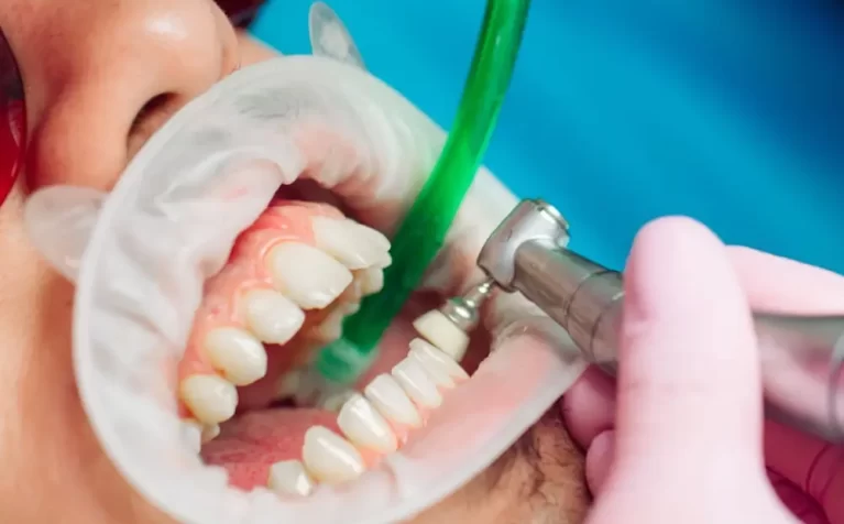 teeth-cleaning-importance-procedure-and-tips-for-a-healthy-smile