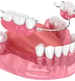 what-are-fixed-partial-dentures