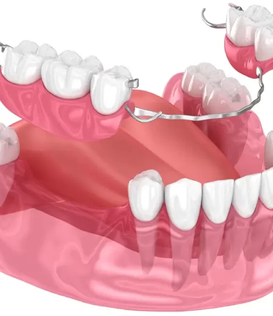 what-are-fixed-partial-dentures
