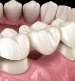 what-to-expect-during-a-dental-crown-procedure