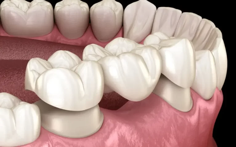 what-to-expect-during-a-dental-crown-procedure